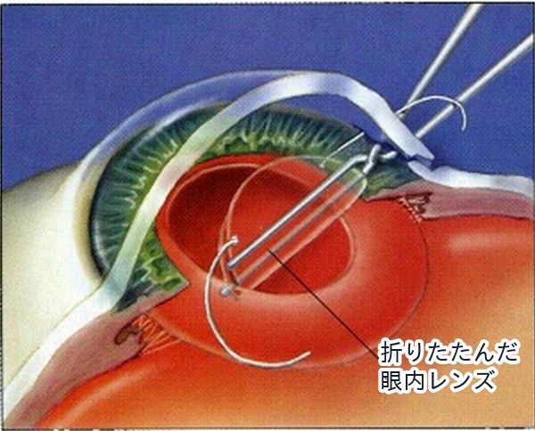 白内障手術の流れ 3：眼内レンズを入れる。折りたたんだ眼内レンズを挿入すると、目の中でレンズが広がります。