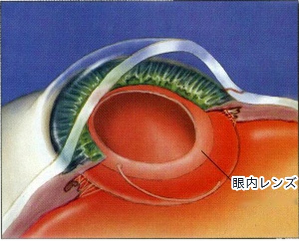白内障手術の流れ 4：手術終了。眼内レンズが所定の位置におさまります。小さな切開は、通常は縫わずに自然に閉じます。