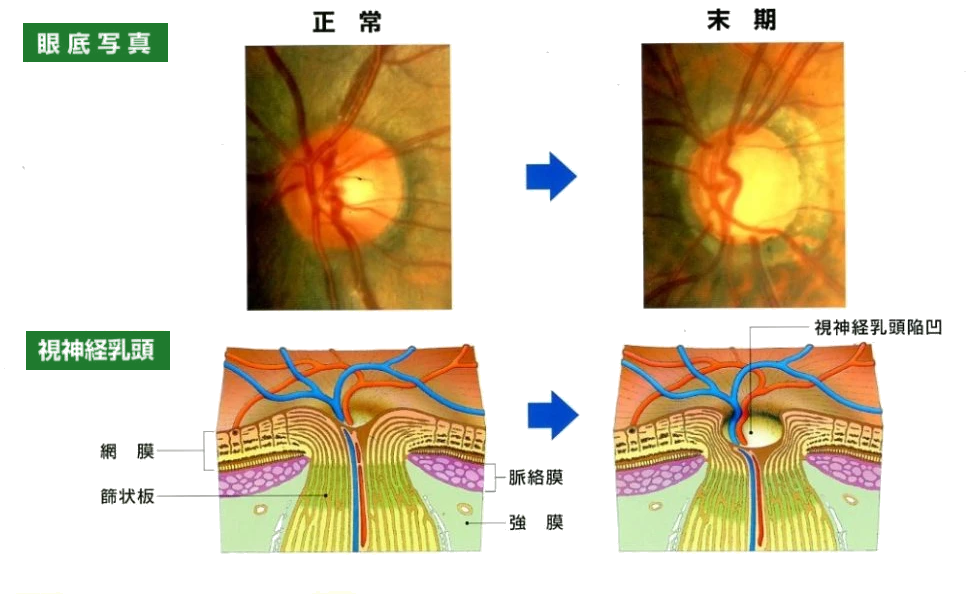 正常な眼と末期の緑内障の眼の比較。上段は眼底写真で、末期では視神経乳頭のくぼみ（陥凹）が大きくなっている。下段は視神経乳頭の断面図で、末期では神経線維が減って視神経乳頭陥凹が深く広がっている。